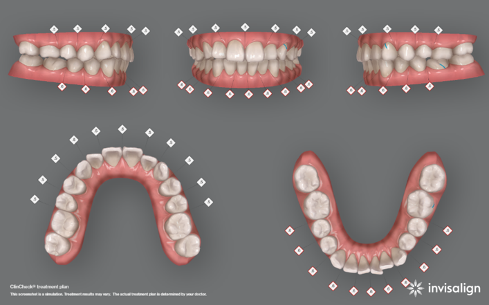 インビザラインによるマウスピース矯正の体験談 蒲田の歯医者なら 菊地歯科医院